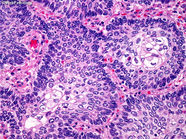 Lung_Neoplastic_SquamousCellCA22_Basaloid.jpg