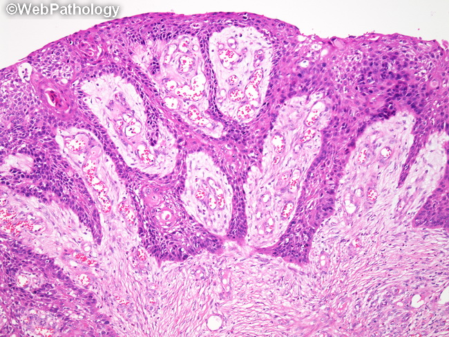 squamous cell papilloma webpathology colon help slim