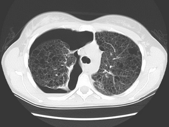 Lungs_LAM_Radiology2.jpg