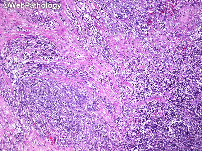 LymphNode_PalisadedMyofibroblastoma1A.jpg