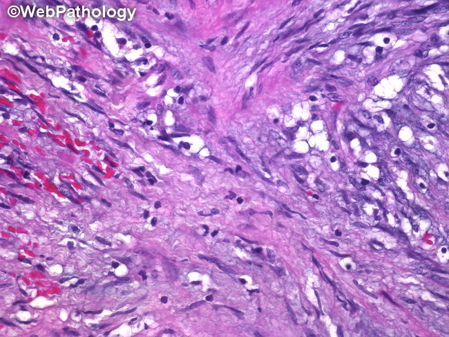LymphNode_PalisadedMyofibroblastoma4A.jpg