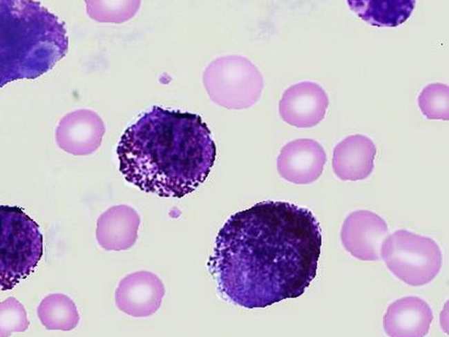 Mast_cell_leukemia_resized.jpg
