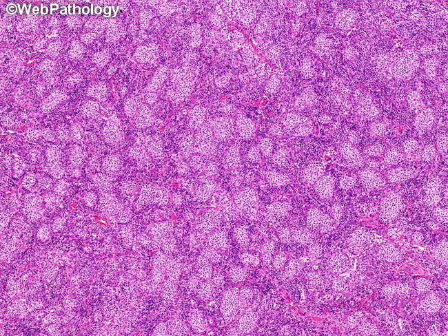 Mastocytosis_LymphNode17.jpg