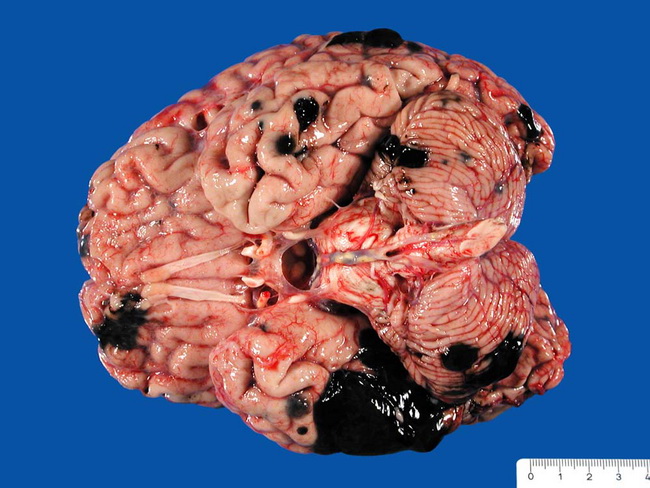 Melanoma_Metastases_Brain1_resized.jpg