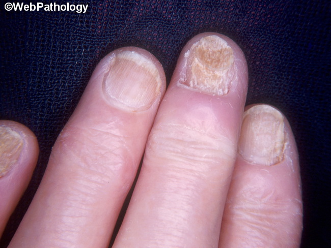 Nails_Dystrophy2_Diabetes.jpg