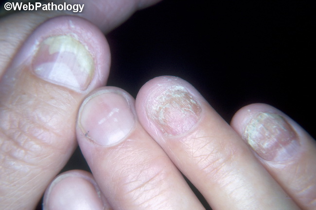 Nails_FungalInfection6.jpg