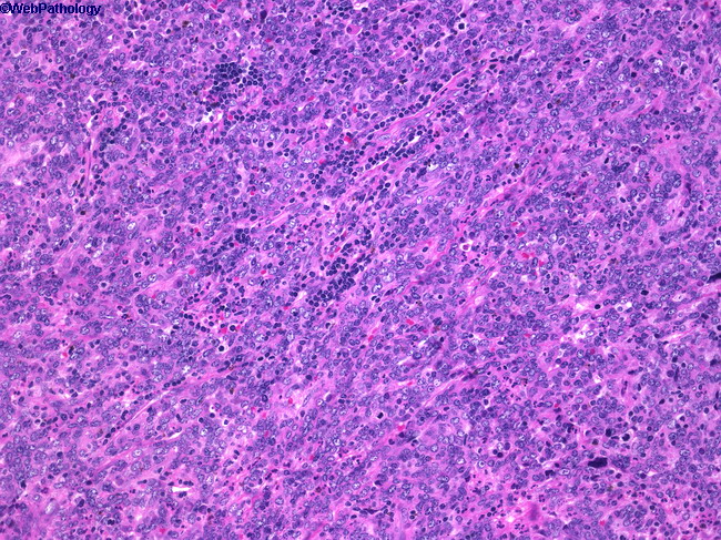 NasopharyngealCarcinoma1.jpg
