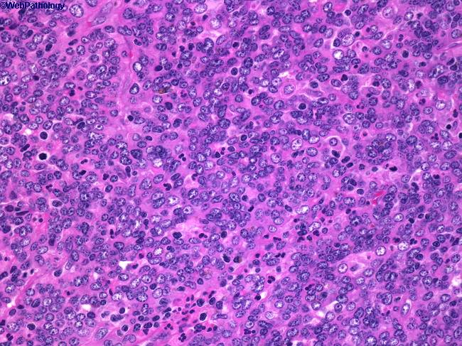NasopharyngealCarcinoma2.jpg