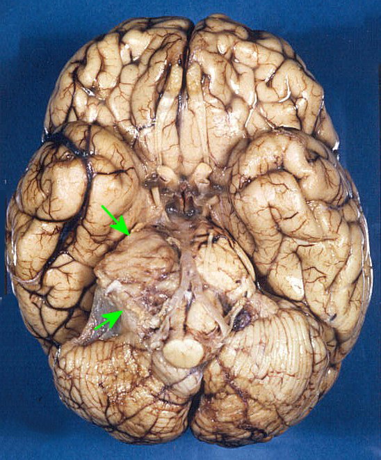 Neurofibromatosis2_VestibularSchwannoma1_cropped.jpg