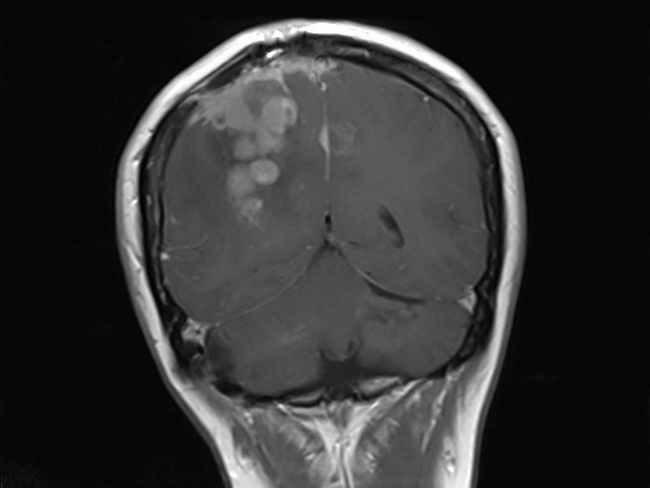 Neurofibromatosis2_VestibularSchwannomas4B_resized.jpg