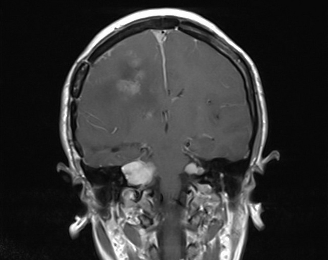 Neurofibromatosis2_VestibularSchwannomas4_resized.jpg