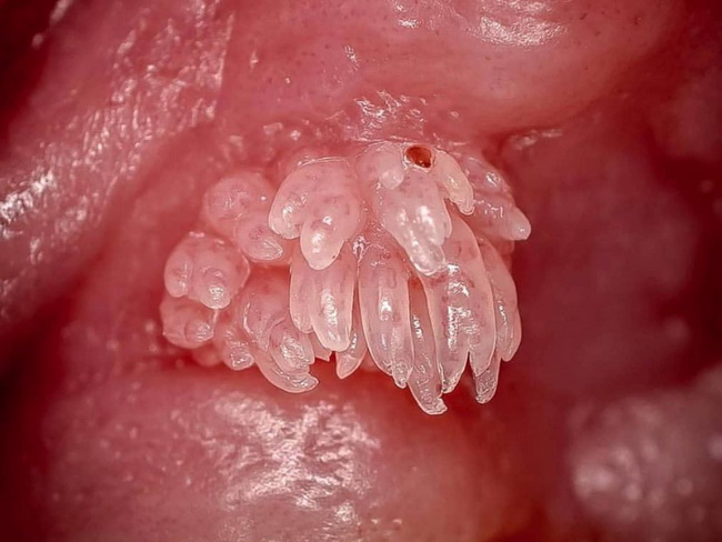 Lip papilloma. Squamous papilloma floor of mouth