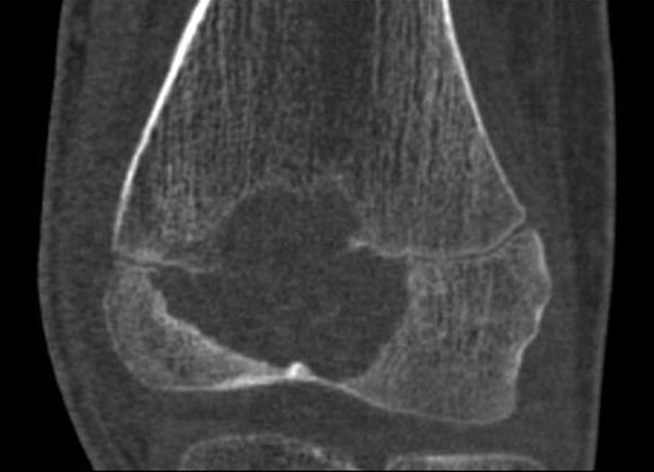 Orthopedic_Chondroblastoma_Radiology2_Copy.jpg