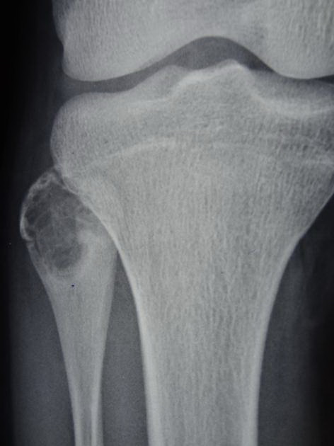 Orthopedic_Chondroblastoma_Radiology4_Copy.jpg