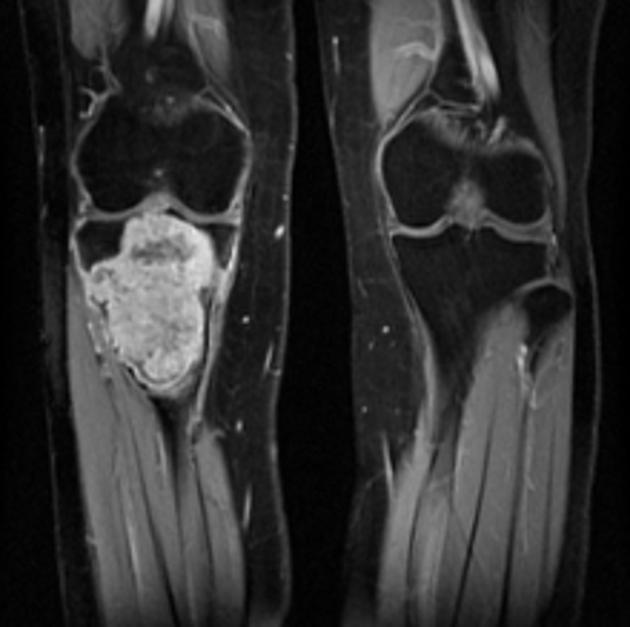 Orthopedic_ChondromyxoidFibroma_MRI2.jpg
