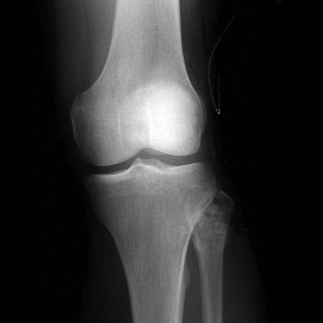 Orthopedic_Osteoblastoma_Radiology1.jpg