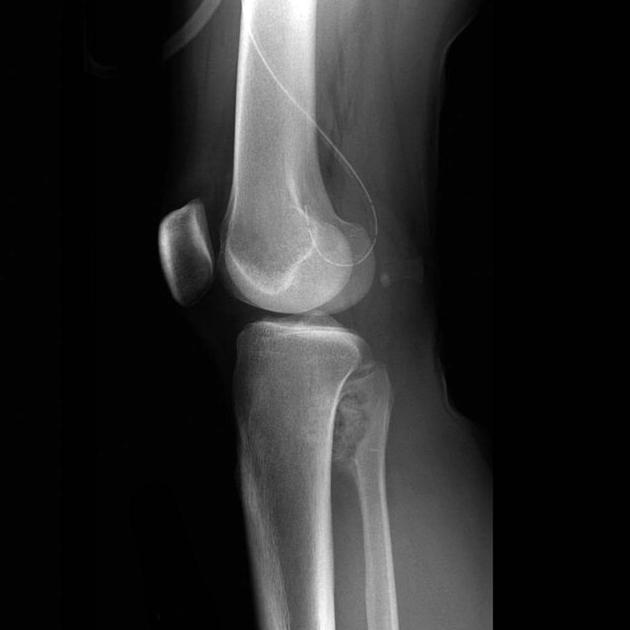 Orthopedic_Osteoblastoma_Radiology2.jpg