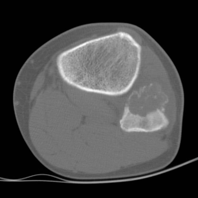 Orthopedic_Osteoblastoma_Radiology3.jpg