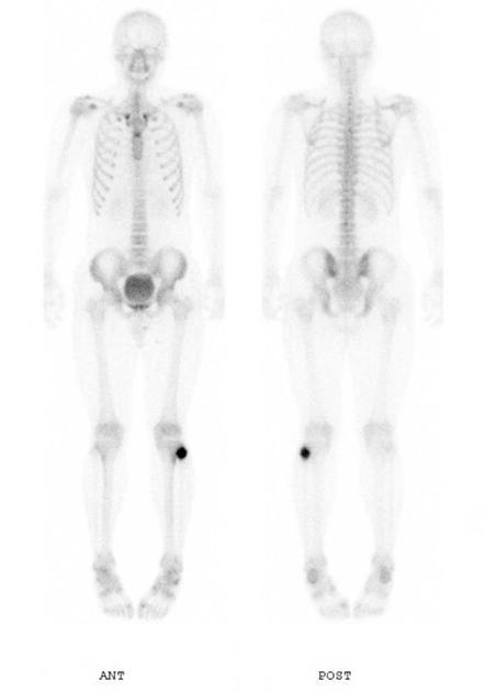 Orthopedic_Osteoblastoma_Radiology4.jpg