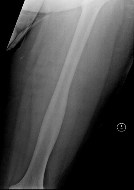 Orthopedic_OsteoidOsteoma_Radiology2A.jpg