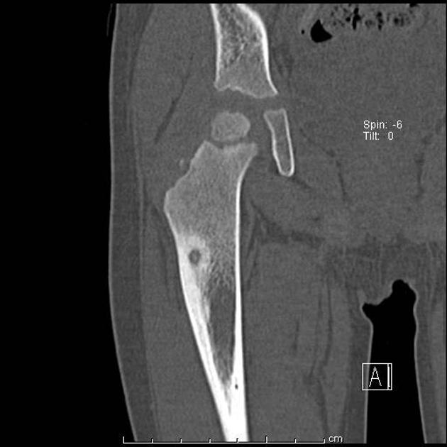 Orthopedic_OsteoidOsteoma_Radiology3.jpg