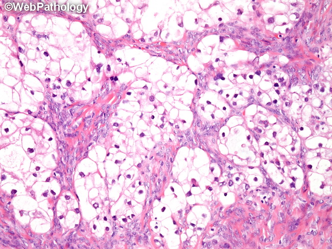 Ovary_CCC69_clearcells.jpg