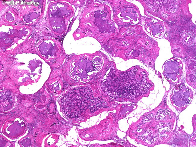 Ovary_Gonadoblastoma1A.jpg