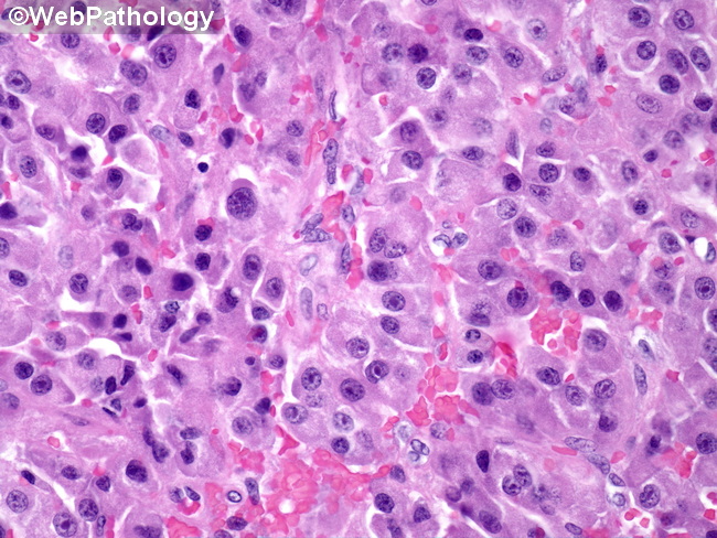 Ovary_SteroidCellTumor27_nuclear_atypia.jpg