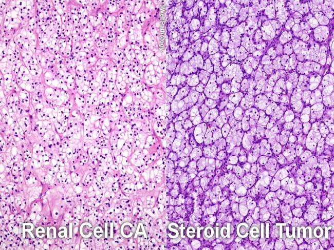 Ovary_SteroidCellTumor_Differential1_resized.jpg