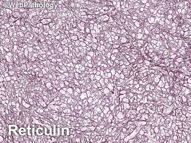 Ovary_Thecoma_Reticulin4_resized.jpg