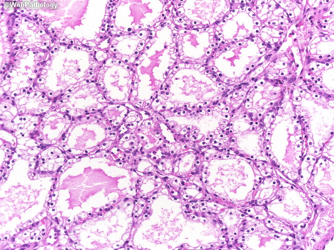 Pancreas_MicrocysticCystadenoma12.jpg