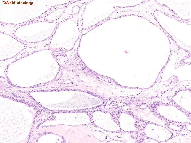 Pancreas_MicrocysticCystadenoma2.jpg