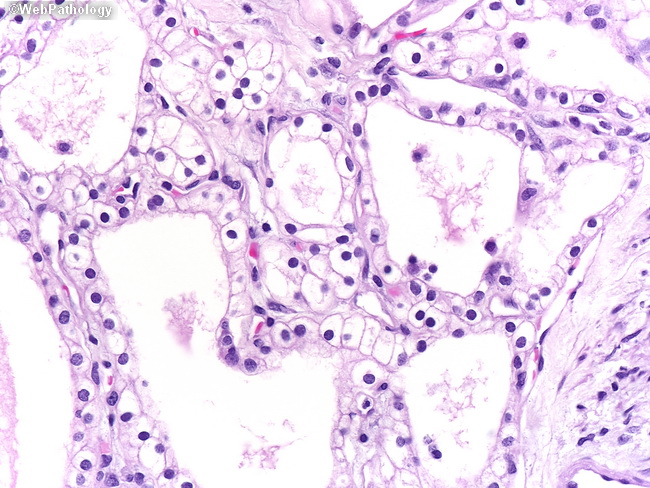 Pancreas_MicrocysticCystadenoma4.jpg