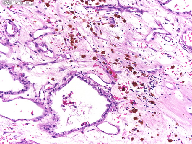 Pancreas_MicrocysticCystadenoma5.jpg