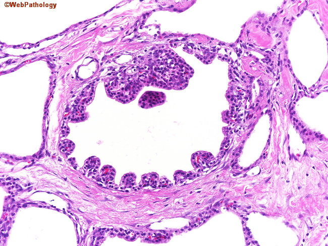 Pancreas_MicrocysticCystadenoma7_PapillaryFoci.jpg