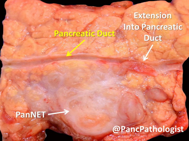 Pancreas_PanNET131_resized.jpg