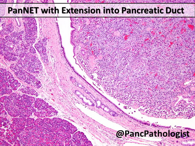 Pancreas_PanNET132_resized.jpg