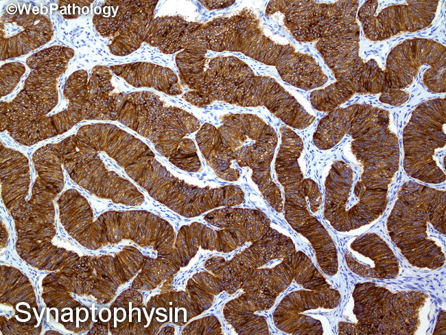 Pancreas_PanNET135_Synaptophysin(1).jpg