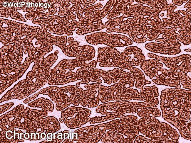 Pancreas_PanNET14_Gr1_Chromogranin(1).jpg