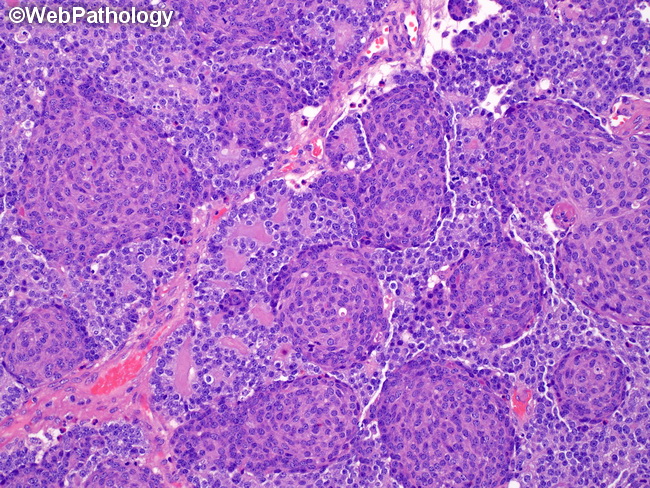 Pancreas_Pancreatoblastoma11.jpg