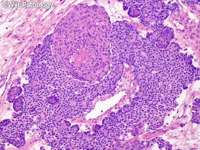 Pancreas_Pancreatoblastoma15.jpg