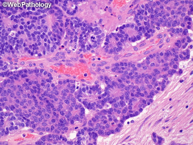 Pancreas_Pancreatoblastoma17.jpg