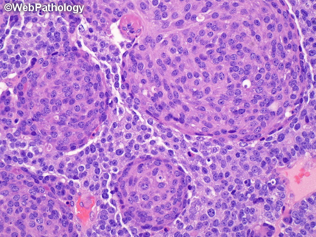 Pancreas_Pancreatoblastoma19.jpg
