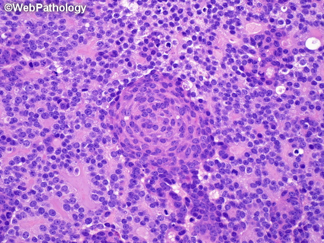Pancreas_Pancreatoblastoma23.jpg