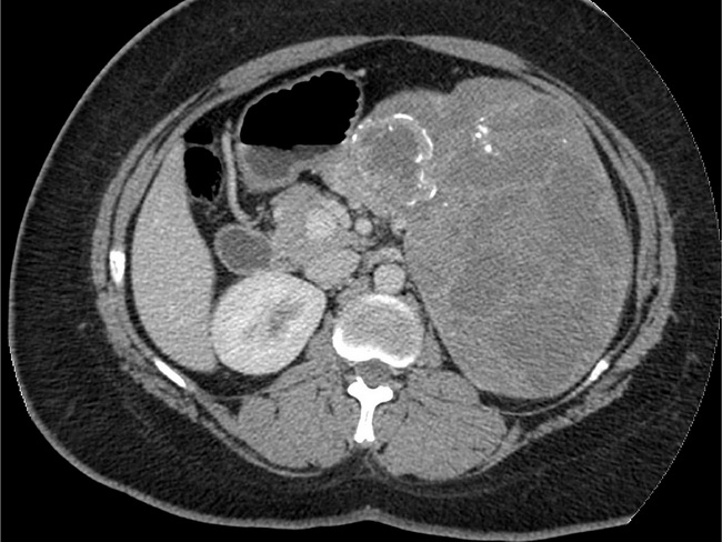 Pancreas_SolidPseudoPapillaryTumor_Radiology1_resized.jpg