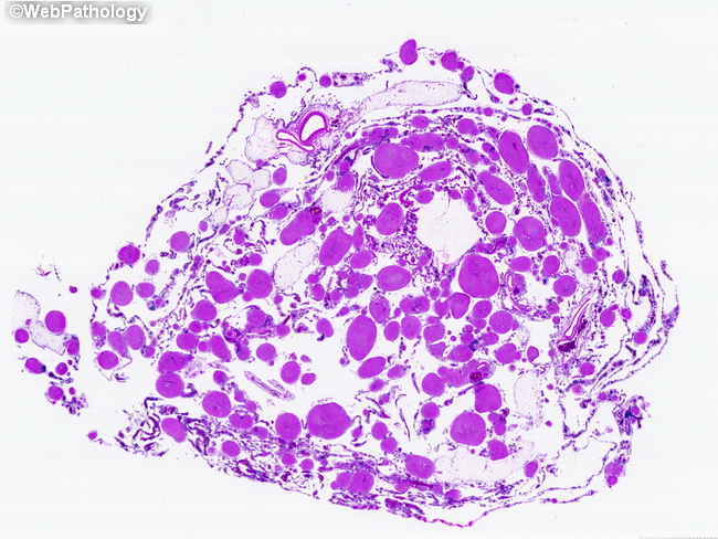 Peritoneum_GliomatosisPeritonei1.jpg