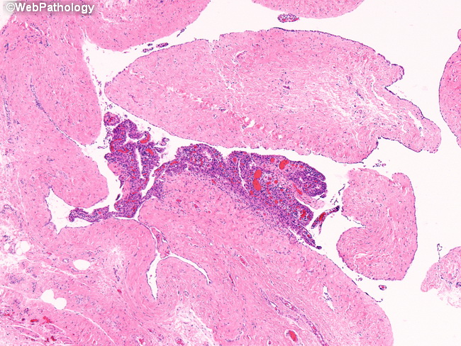 Peritoneum_MesothelialHyperplasia10_Hydrocele.jpg