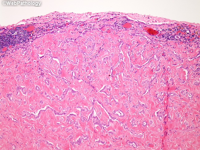 Peritoneum_MesothelialHyperplasia13_Hydrocele.jpg