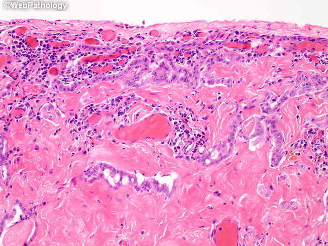 Peritoneum_MesothelialHyperplasia15_Hydrocele.jpg