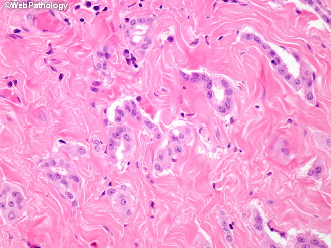 Peritoneum_MesothelialHyperplasia17_Hydrocele.jpg